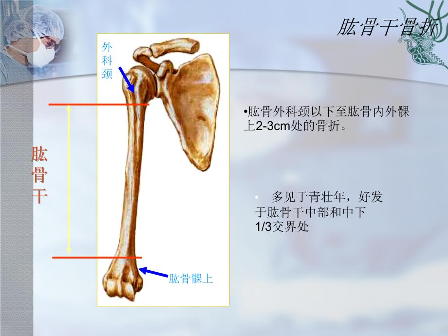 肱骨干骨折课件_第2页