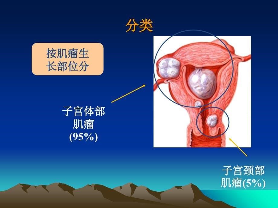 子宫肌瘤护理查房_第5页