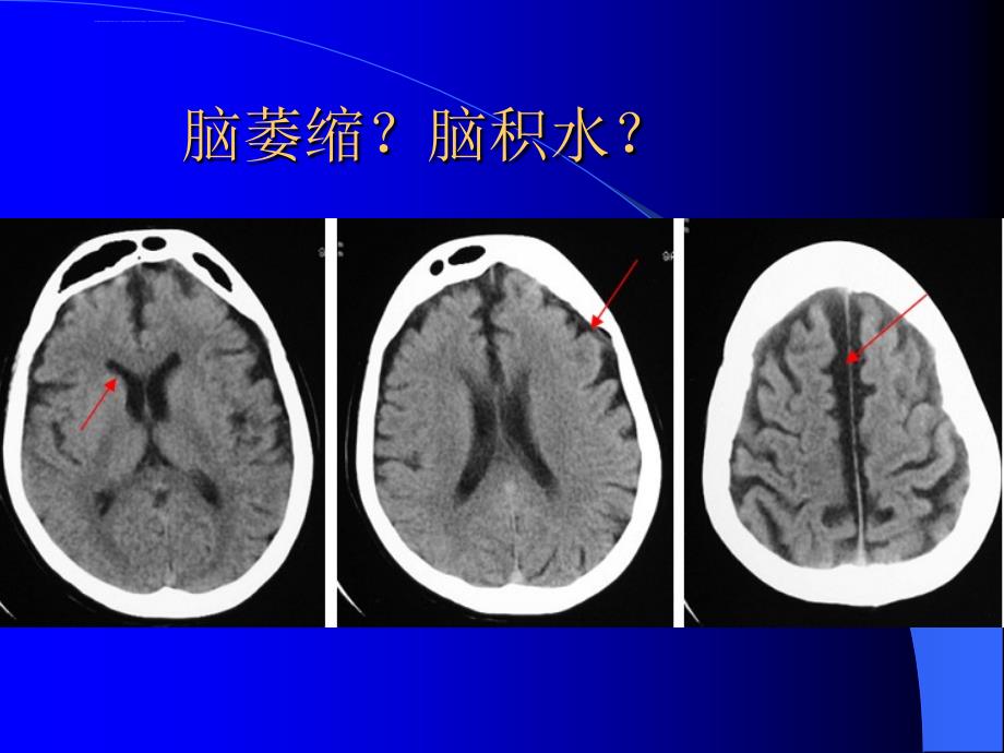 脑积水与脑萎缩的CT和MRI诊断ppt课件_第2页