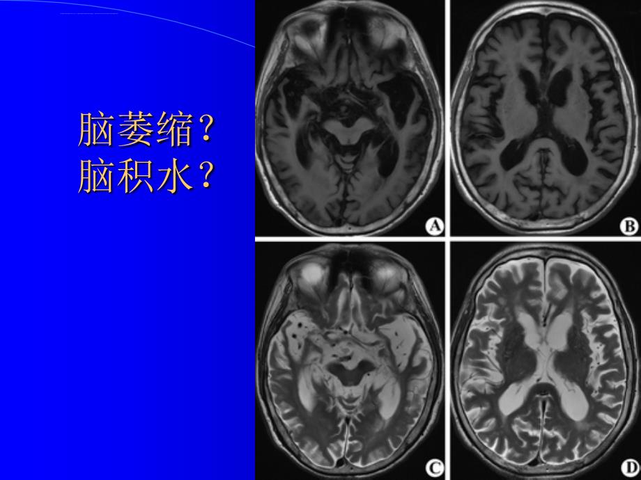 脑积水与脑萎缩的CT和MRI诊断ppt课件_第3页