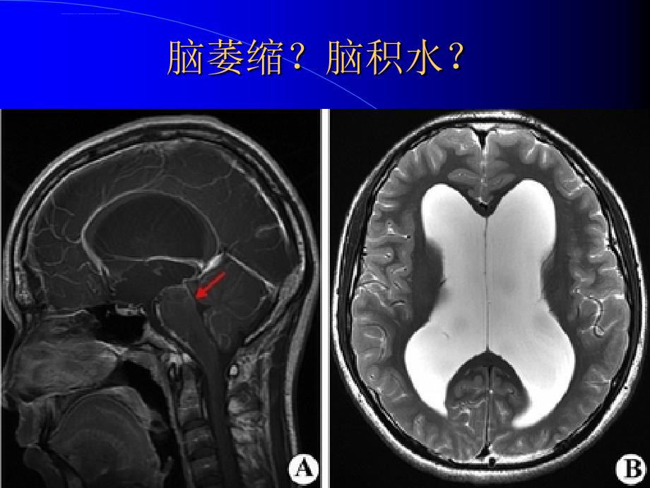 脑积水与脑萎缩的CT和MRI诊断ppt课件_第4页