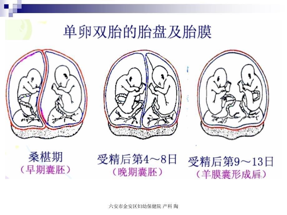 双胎妊娠膜性诊断与双胎特有并发症精要_第5页