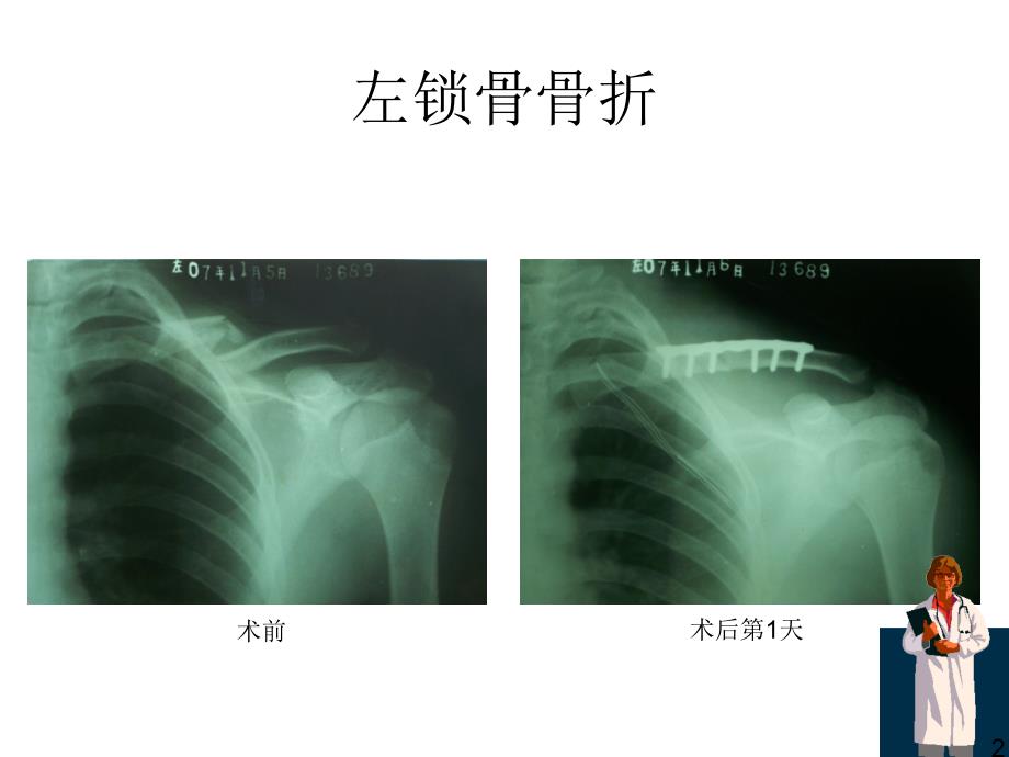 骨折x线片汇总ppt课件_第2页