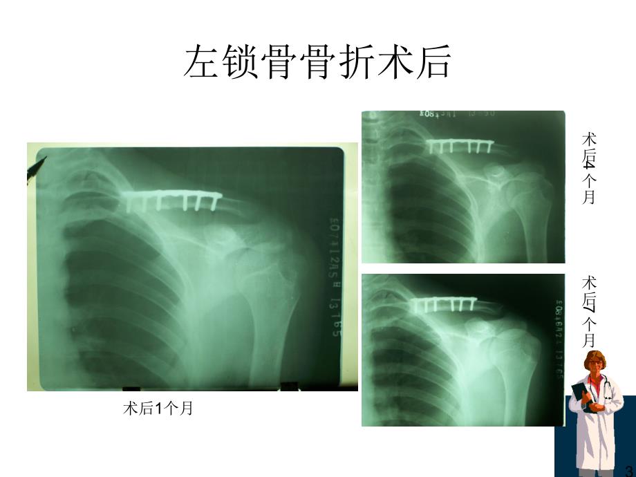 骨折x线片汇总ppt课件_第3页