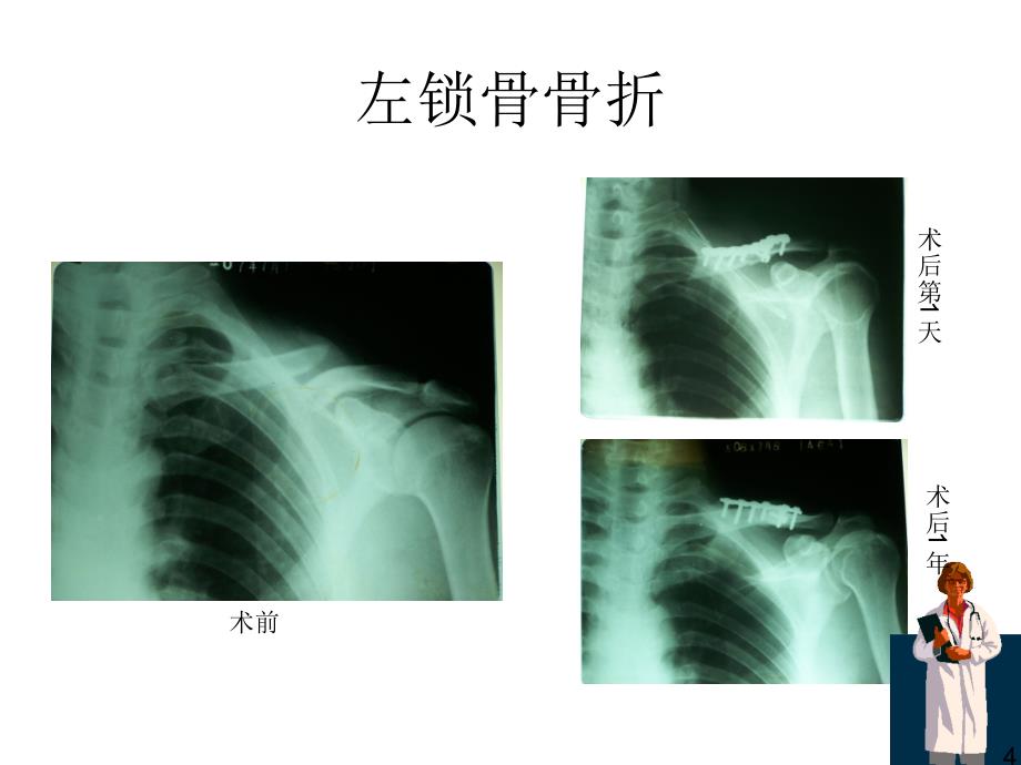 骨折x线片汇总ppt课件_第4页