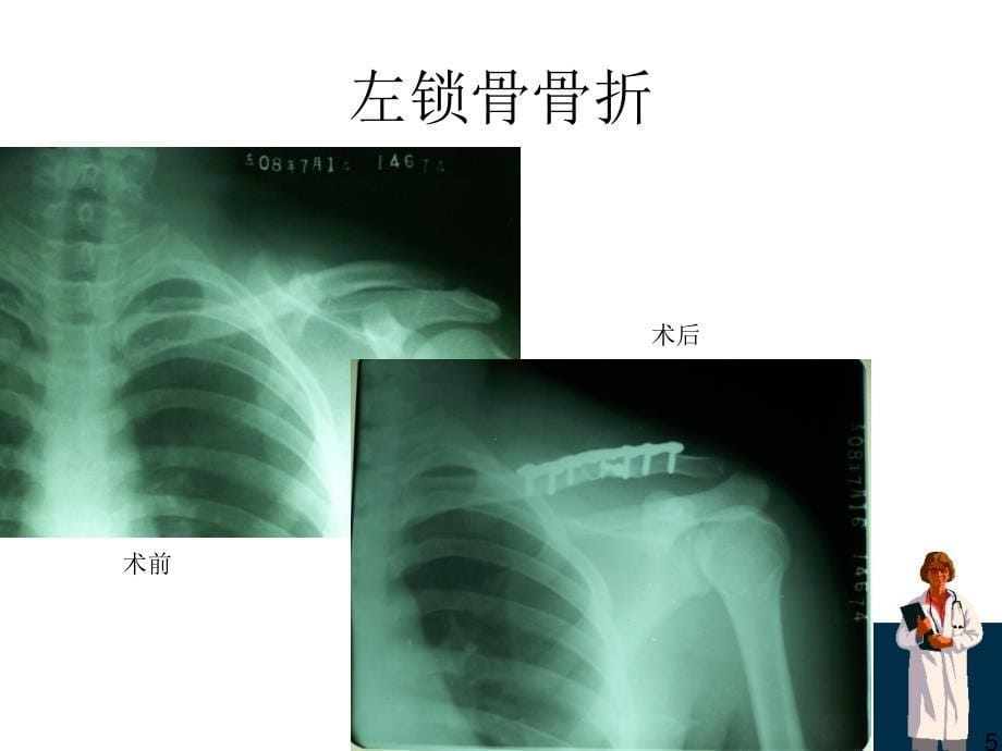 骨折x线片汇总ppt课件_第5页