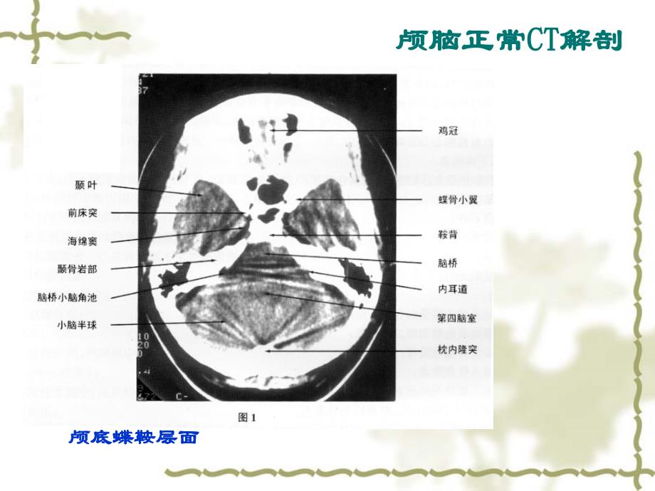 头部CT诊断学PPT课件_第3页