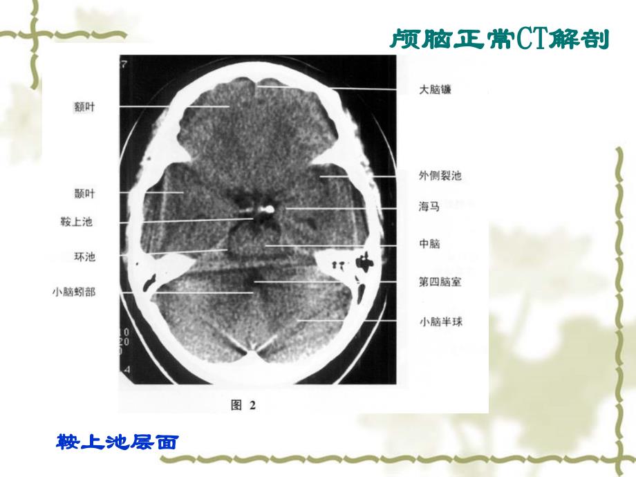 头部CT诊断学PPT课件_第4页