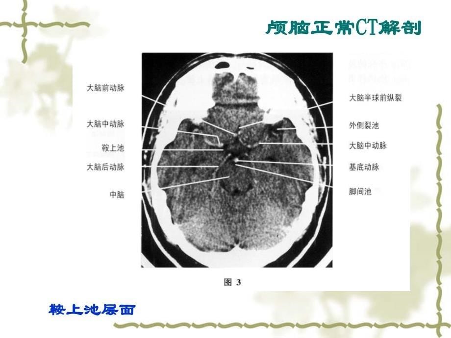 头部CT诊断学PPT课件_第5页