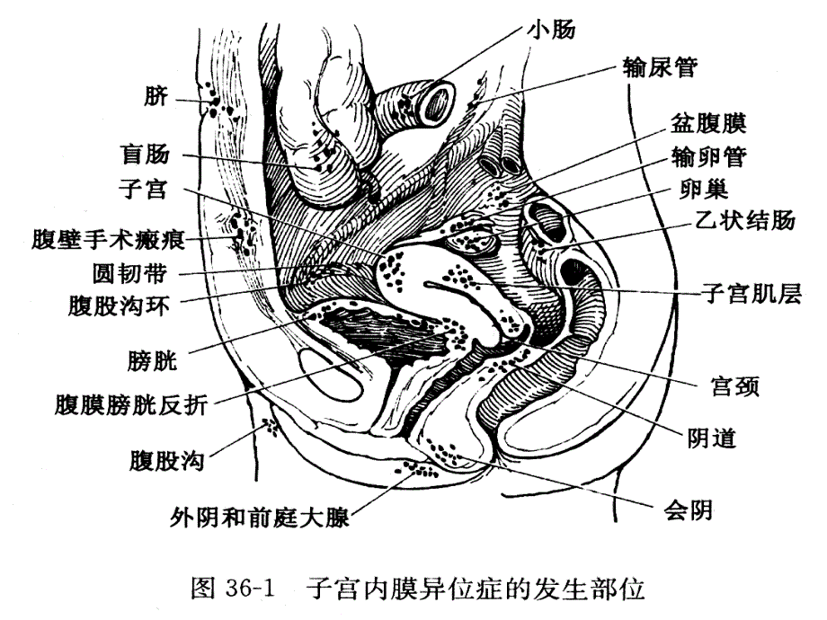 子宫内膜异位症与子宫腺肌病文档资料_第4页