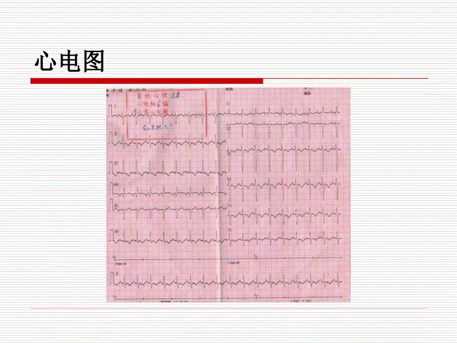 右心衰竭鼻衄动静脉瘘张尉华_第4页