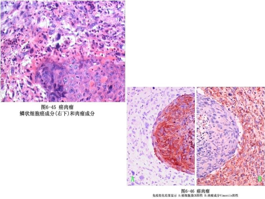 病理解剖学肿瘤_第4页