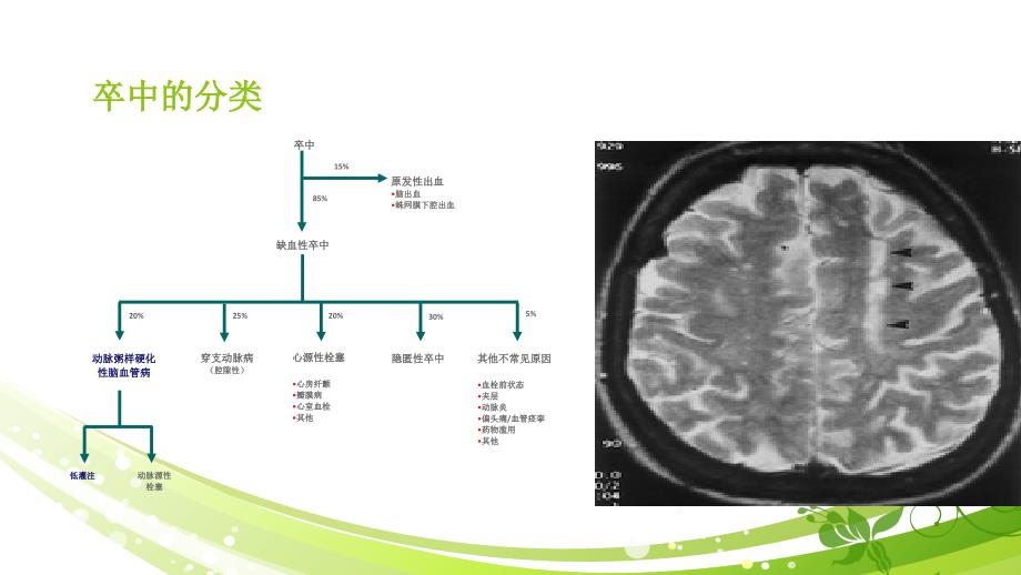 缺血性卒中的诊断策略_第4页