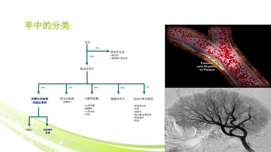 缺血性卒中的诊断策略_第5页