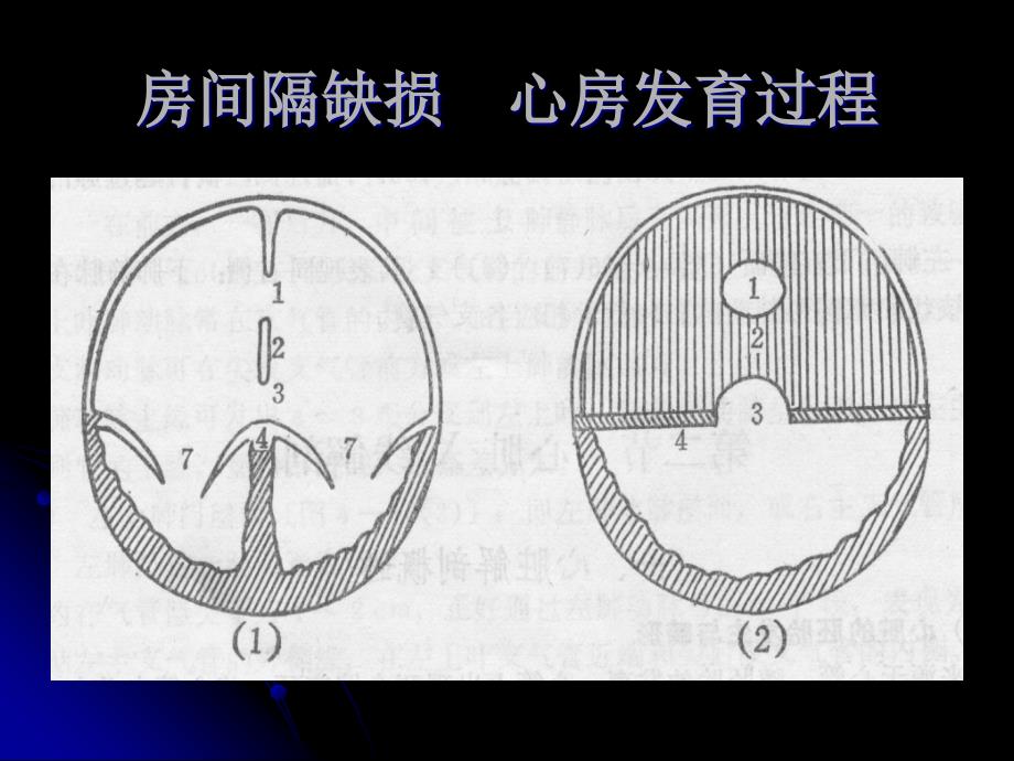 先天性心脏病房间隔缺损_第4页