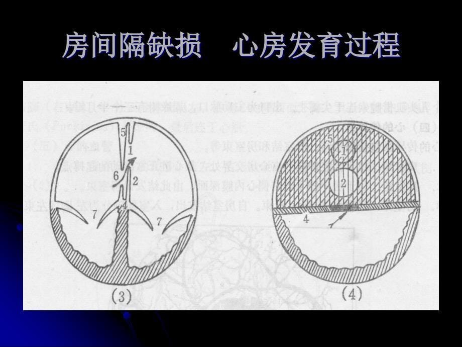 先天性心脏病房间隔缺损_第5页