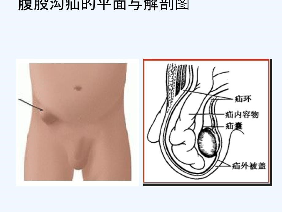 腹腔镜下疝修补术护理查房课件_第5页