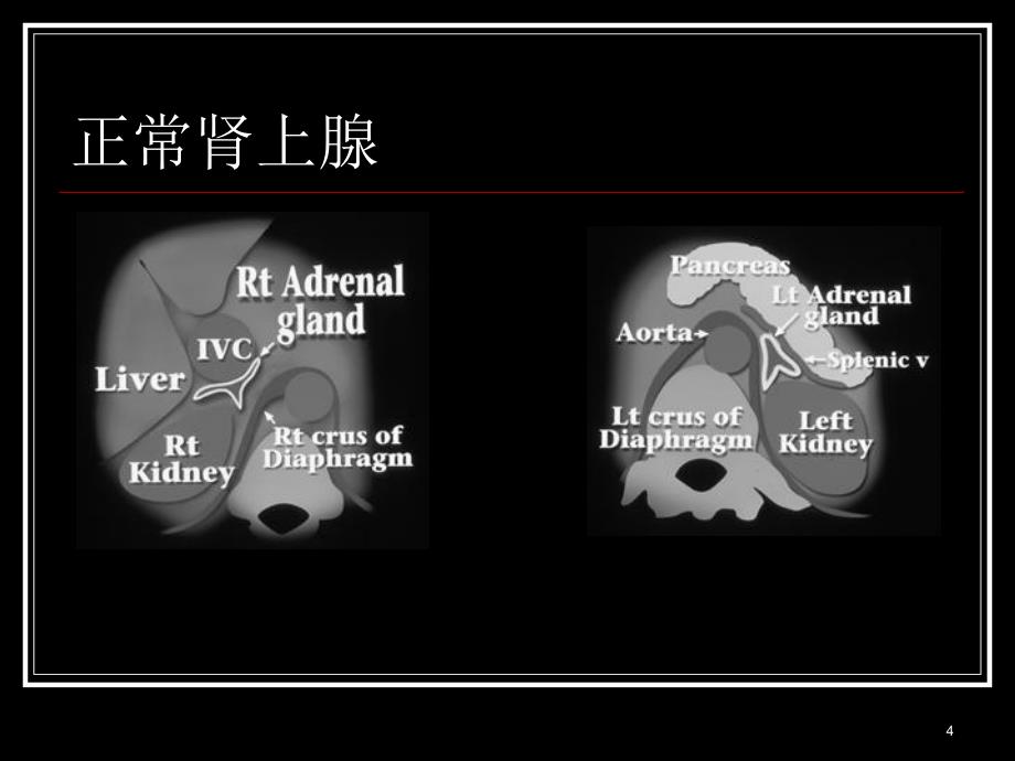 肾上腺疾病CT读片ppt课件_第4页