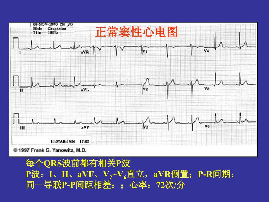 协和医科大学心电图详解_第4页