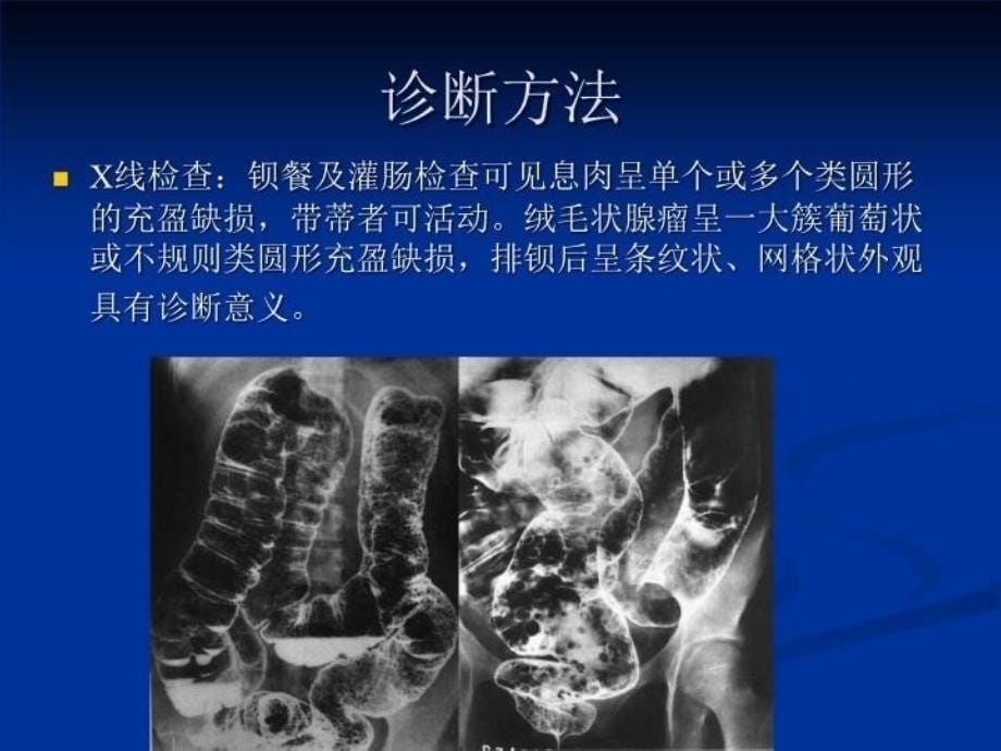 最新大肠息肉病PPT课件_第5页