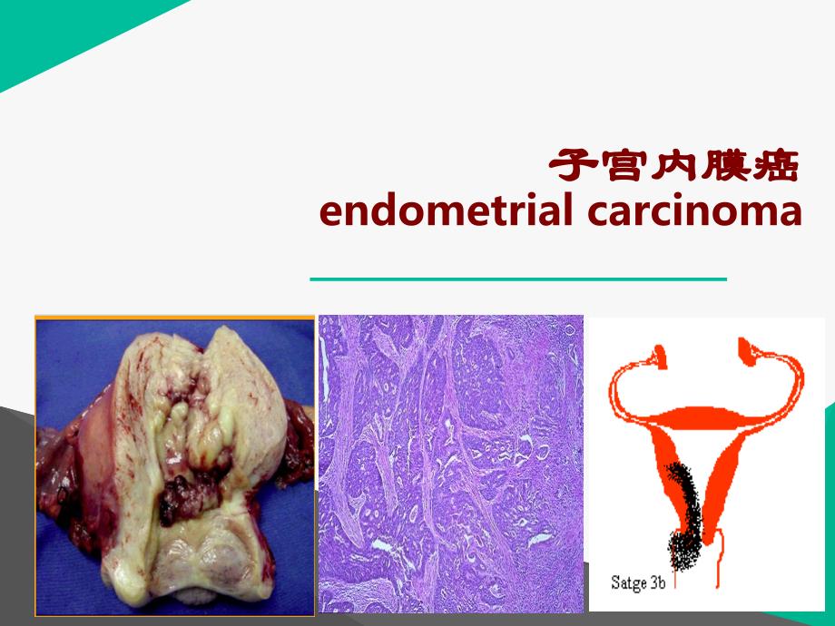 妇科学教学课件：子宫内膜癌_第1页