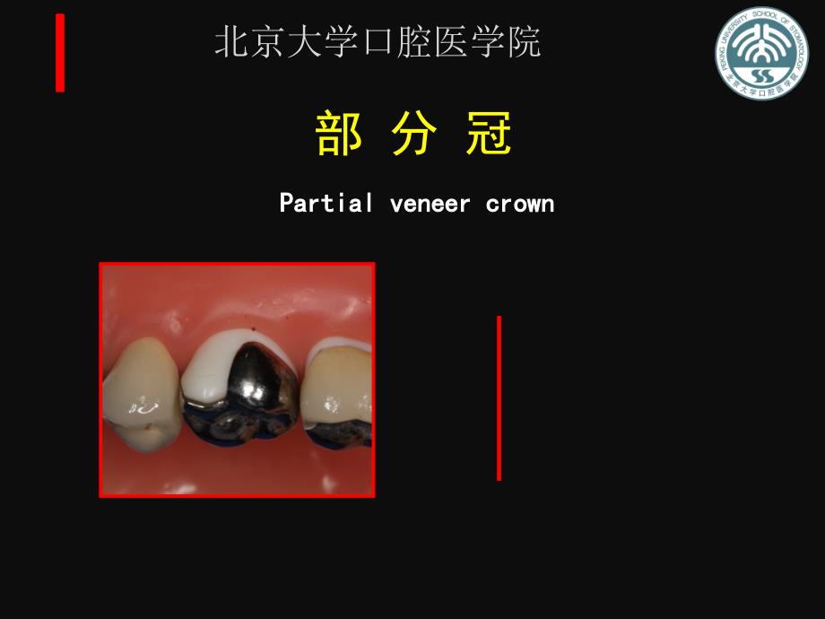 牙体修复：牙体缺损修复-部分冠_第2页