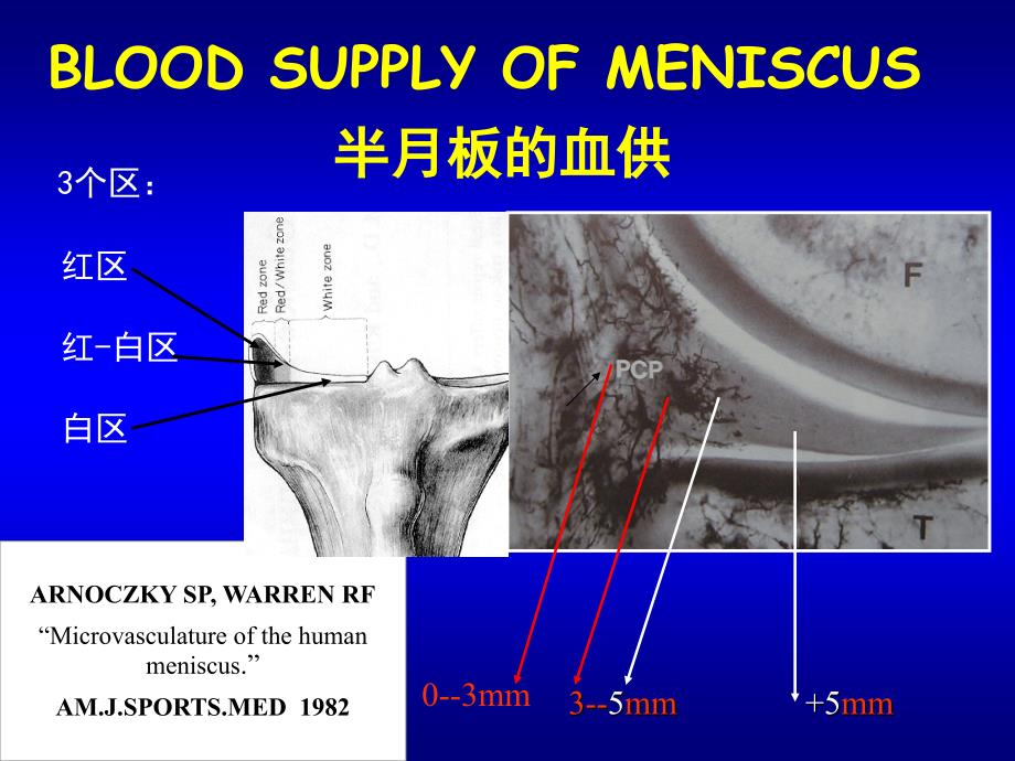 半月板损伤讲课修改版课件_第4页