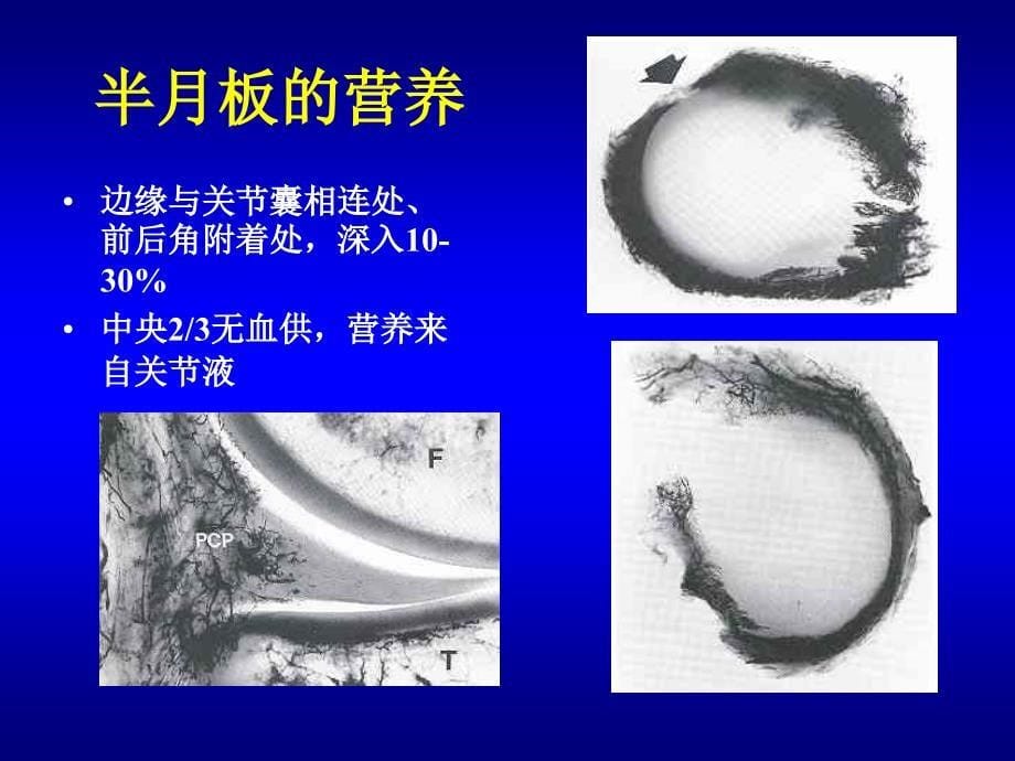 半月板损伤讲课修改版课件_第5页