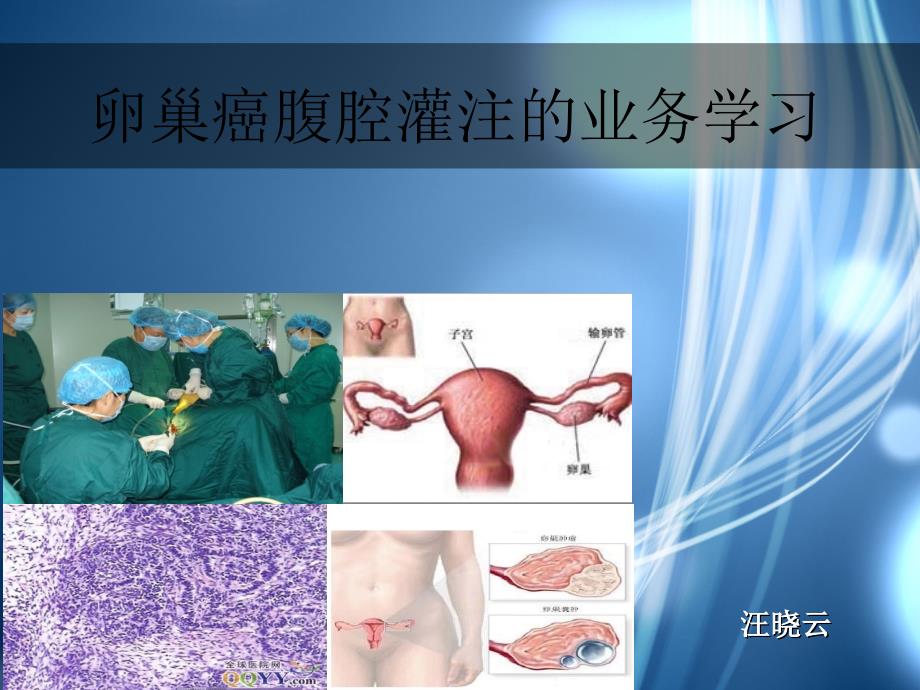 卵巢癌腹腔灌注化疗护理ppt课件_第1页