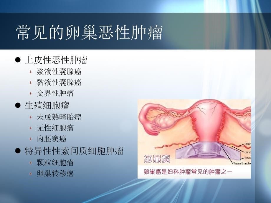 卵巢癌腹腔灌注化疗护理ppt课件_第5页