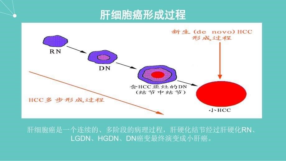 肝硬化结节_第5页