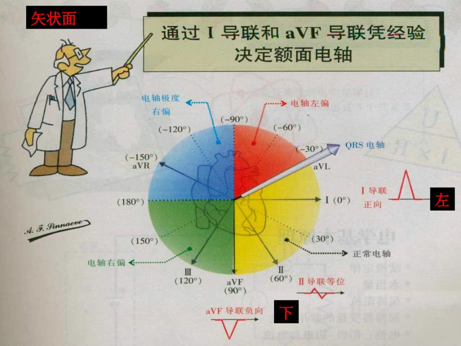 室性期前收缩及室性心动过速的体表心电图定位课件_第3页