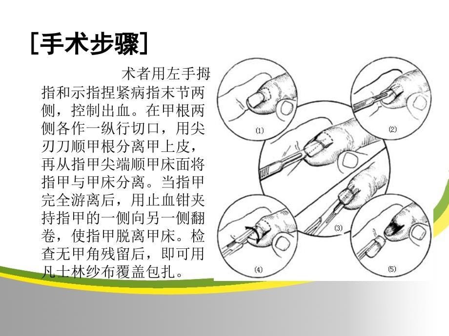 拔甲术幻灯片_第5页