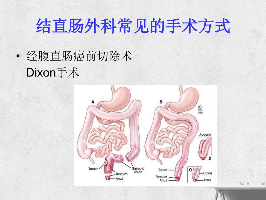 《结肠造口及其护理》课件_第3页