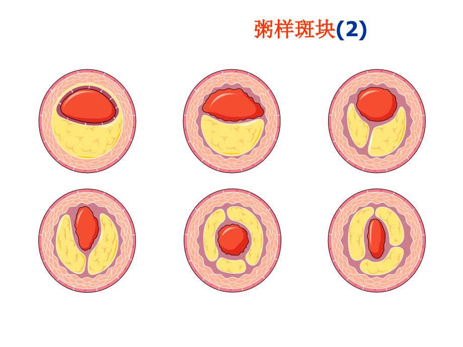 动脉粥样硬化精美图片_第3页