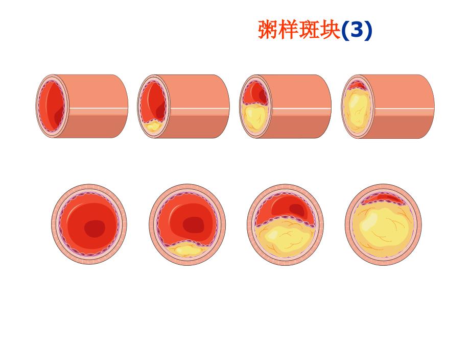 动脉粥样硬化精美图片_第4页