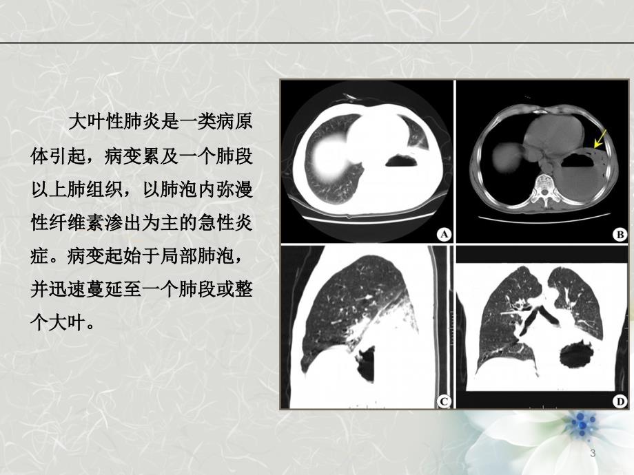 优质课件儿童大叶性肺炎_第3页