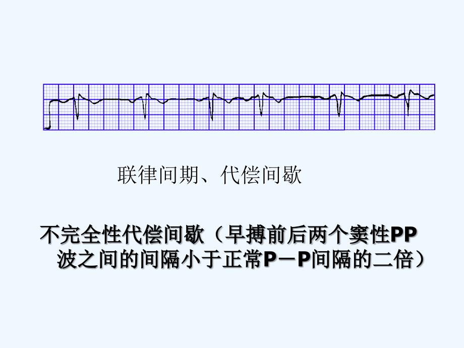 联律间期、代偿间歇 课件_第2页