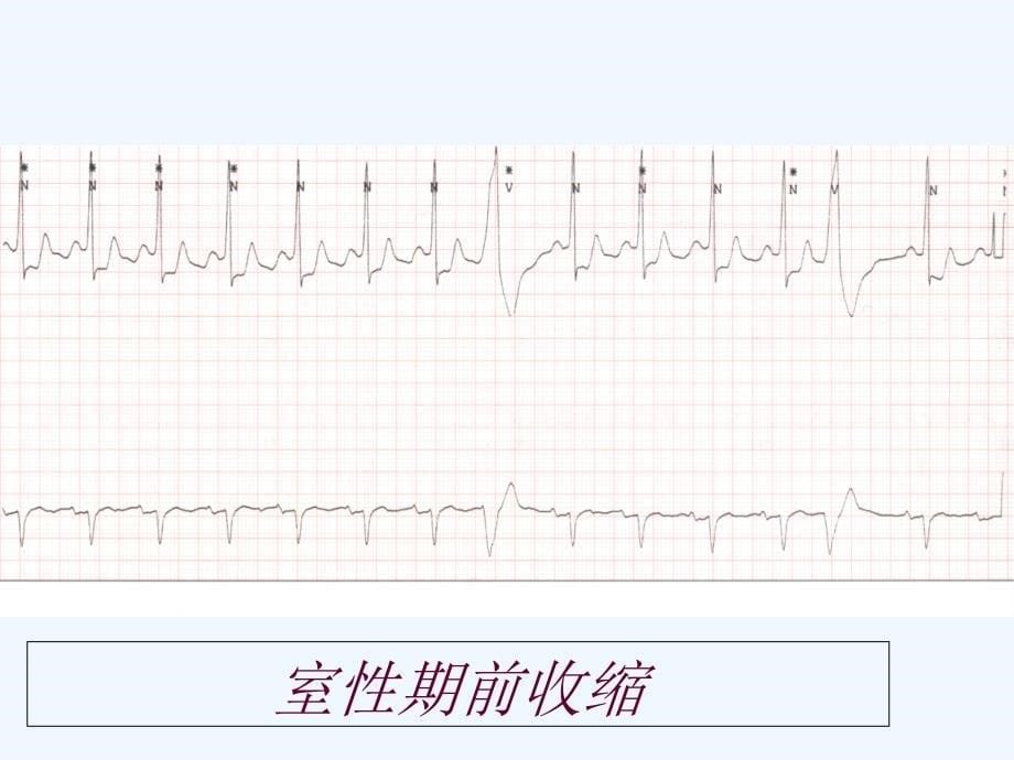 联律间期、代偿间歇 课件_第5页