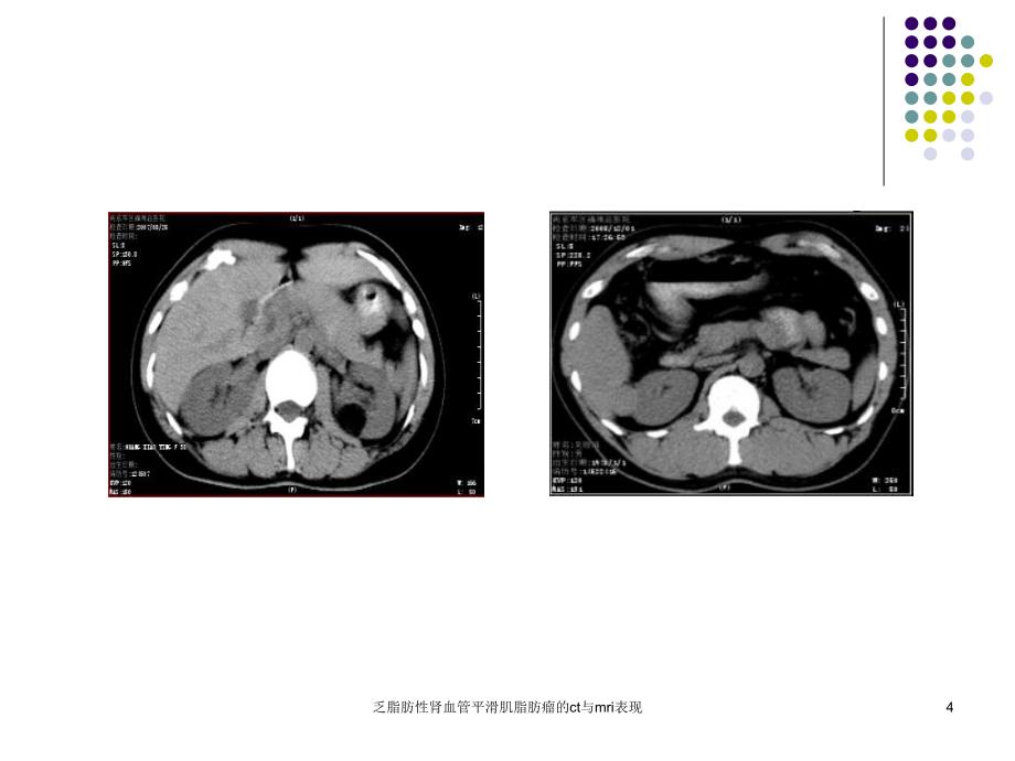 乏脂肪性肾血管平滑肌脂肪瘤的ct与mri表现课件_第4页