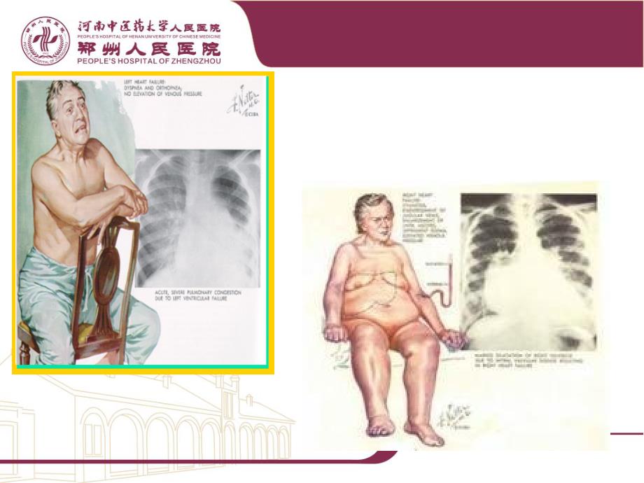 心力衰竭课件_第3页