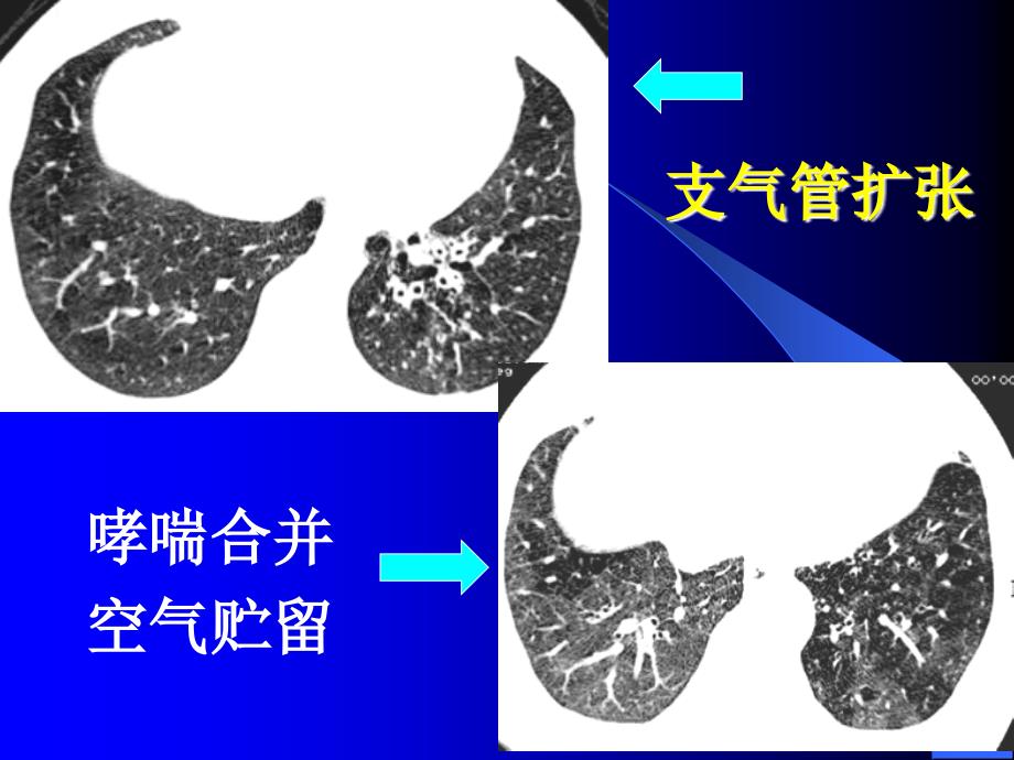 CT的肺功能性成像及其应用_第3页