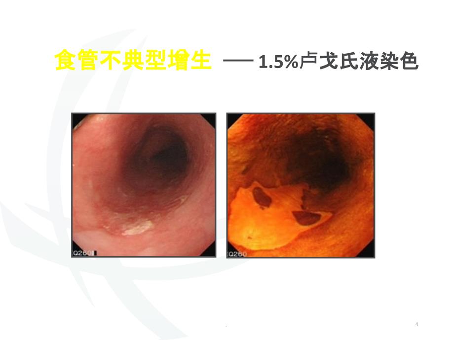 消化道肿瘤内镜下早诊早治PPT课件_第4页