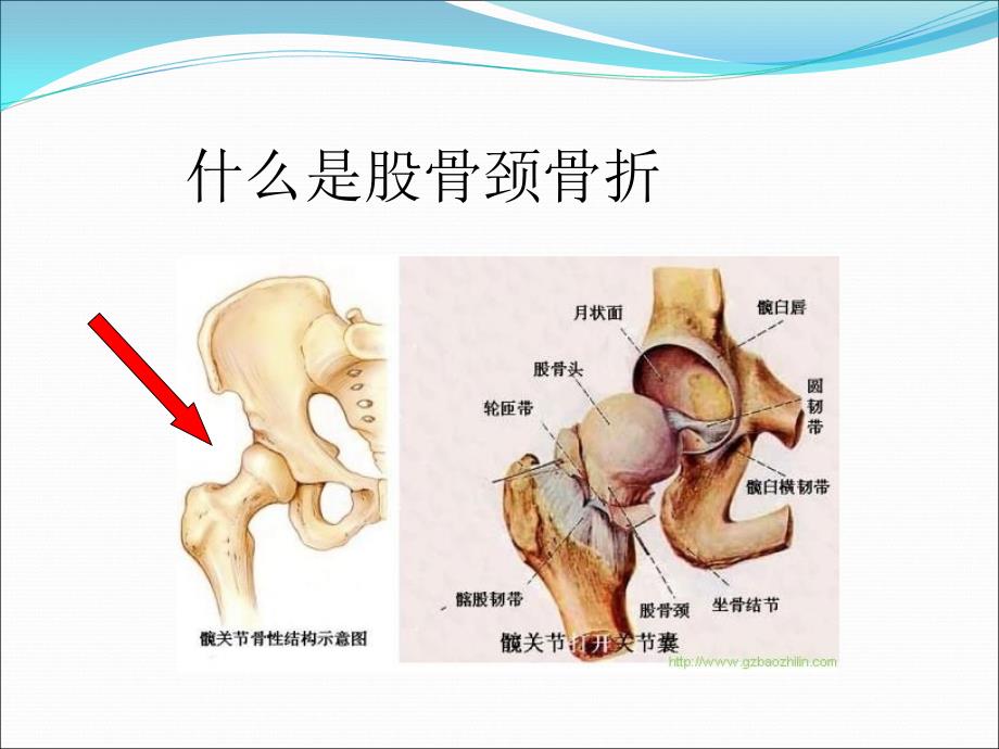 股骨颈骨折髋关节置换术的护理.ppt_第3页