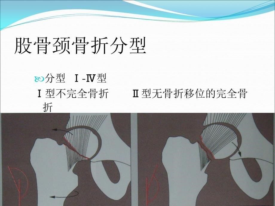 股骨颈骨折髋关节置换术的护理.ppt_第5页