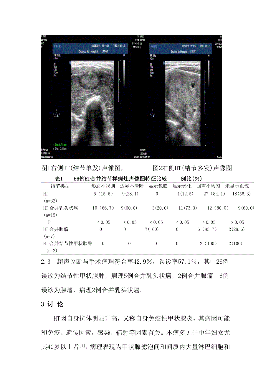 超声诊断桥本甲状腺炎合并结节样病变56例分析_第4页