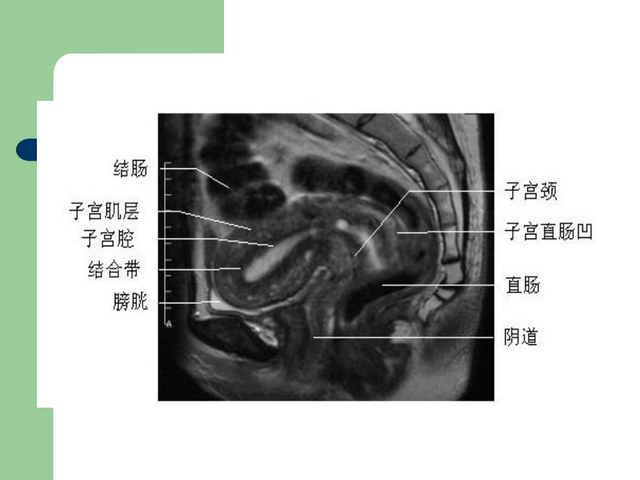 子宫内膜癌的MRI评价.ppt_第4页