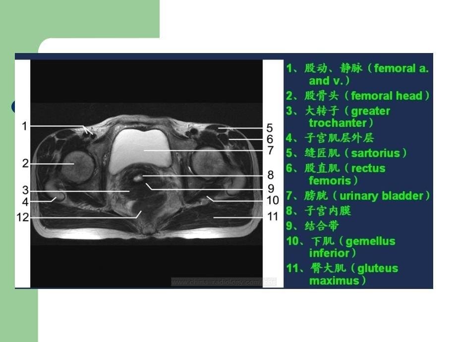 子宫内膜癌的MRI评价.ppt_第5页