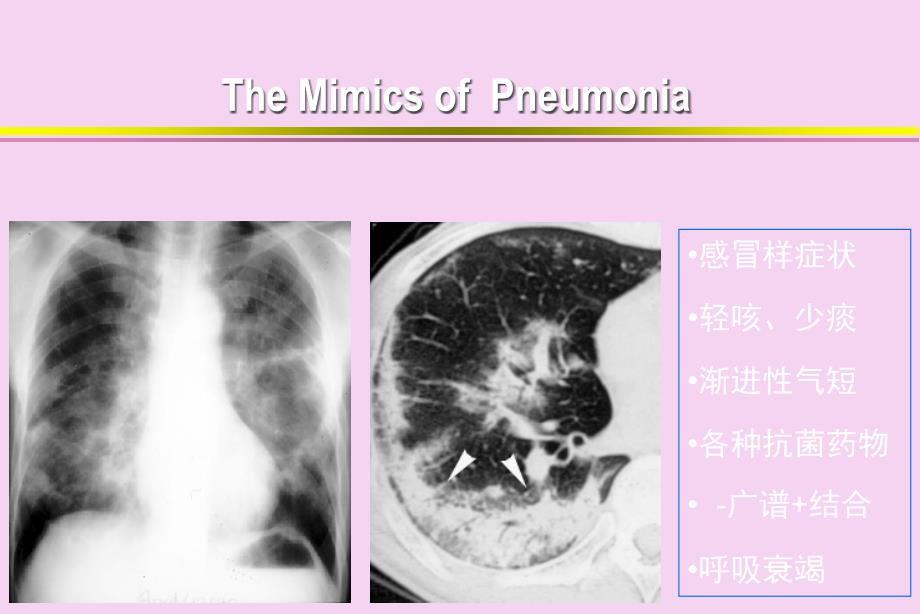 0119耐药背景下CAP的个体化治疗CME2ppt课件_第2页