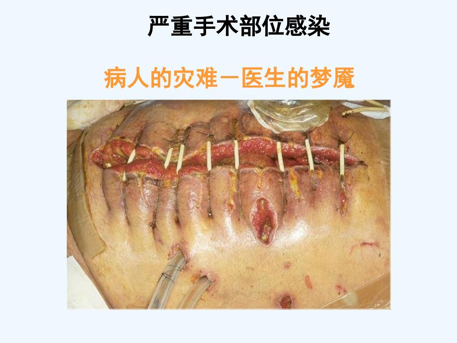 预防性抗菌素与外科部位感染控制8课件_第4页